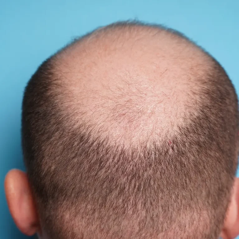Is balding at 25 normal