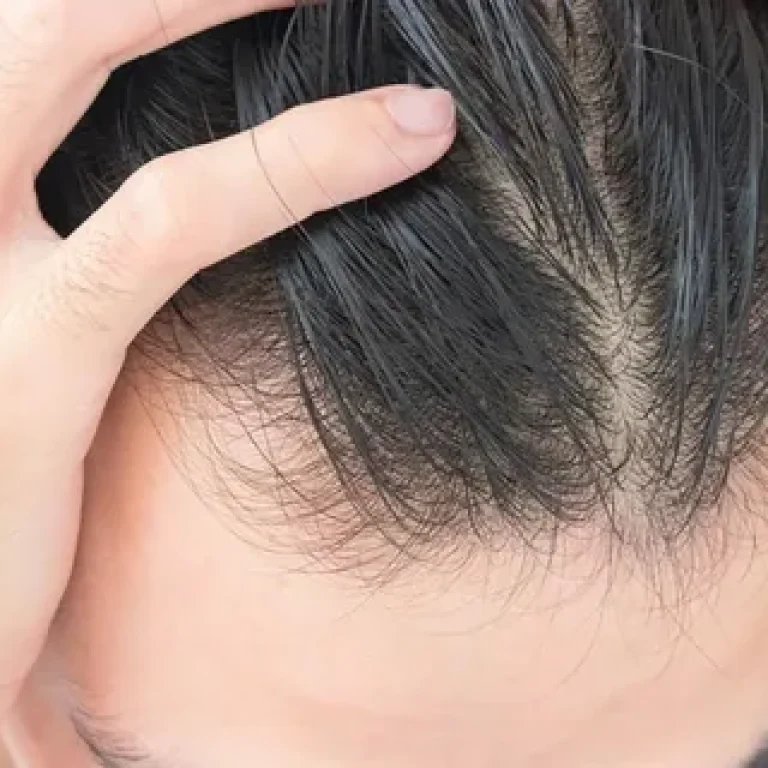 Is thinning of hair permanent