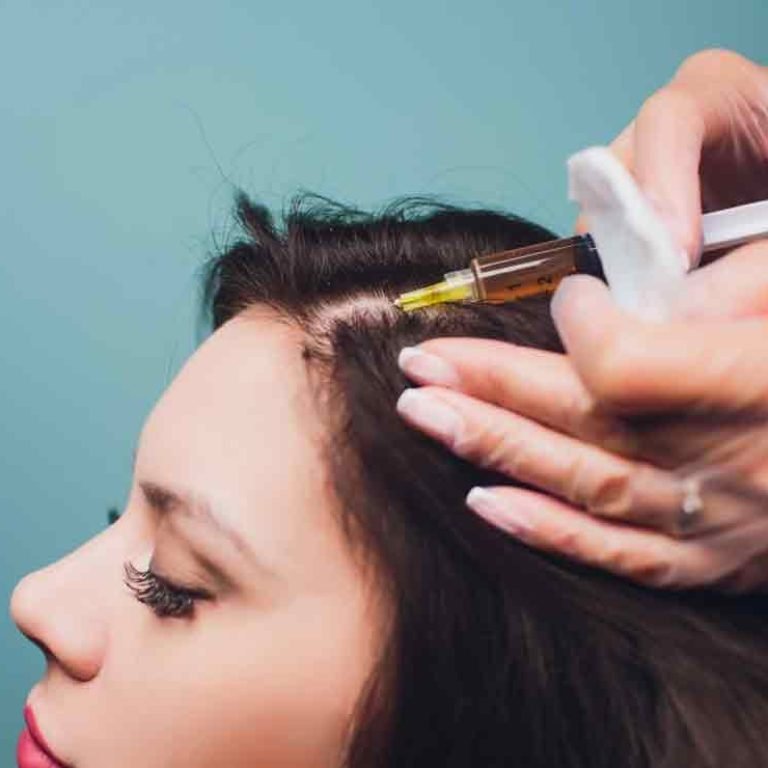 PRP for Hair Loss in San Diego