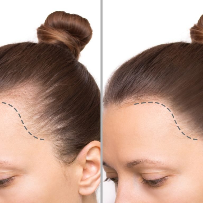 Female Hair Transplant in Islamabad