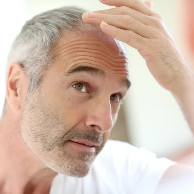 Why Does Surgery Cause Hair Loss