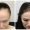Hair Transplant Cost for Females in Pakistan