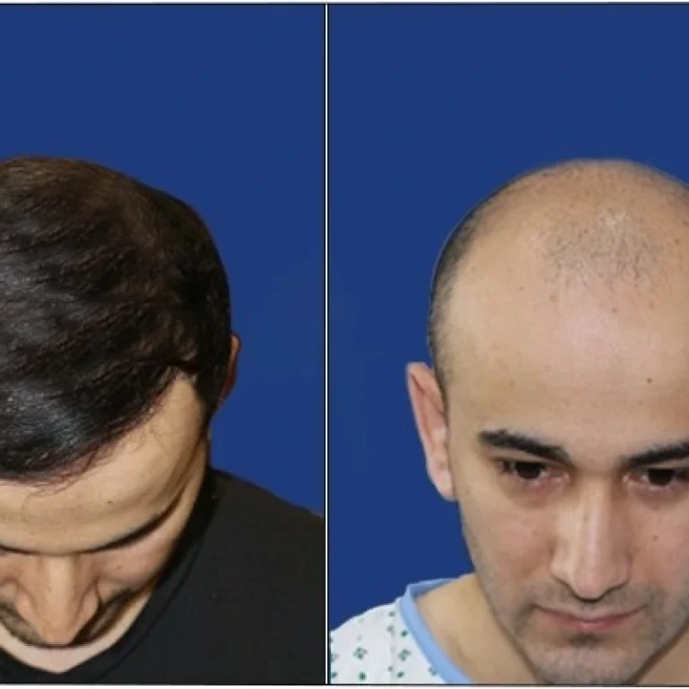 Hair Loss Treatment in Houston
