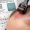 How Often to Microneedle for Hair Loss