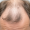 Hair Loss on Semaglutide