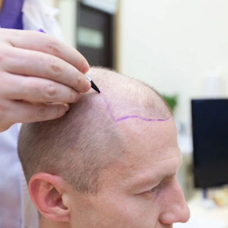 does frontal fibrosing alopecia itch
