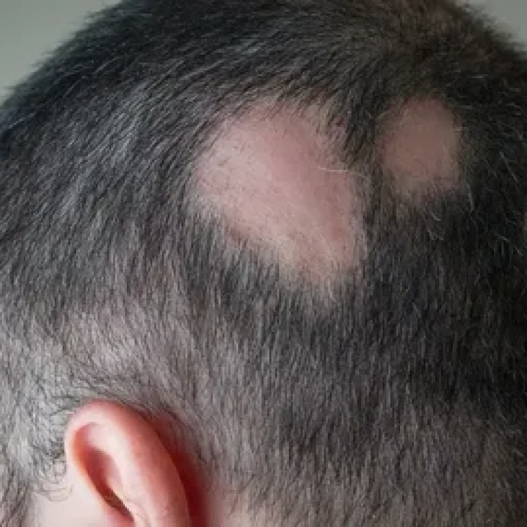 How to Diagnose Alopecia Areata