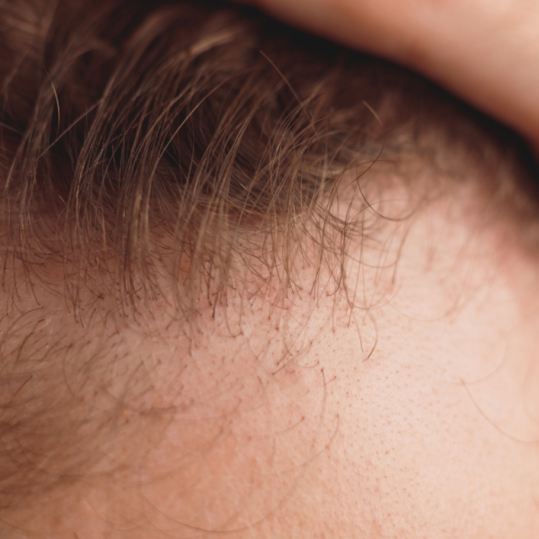 Can Frontal Fibrosing Alopecia Be Reversed