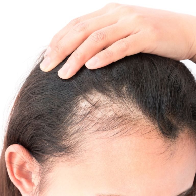 Low Cortisol Cause Hair Loss