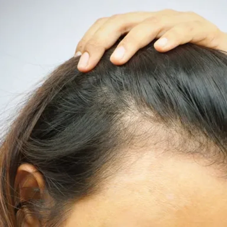 How to Diagnose Alopecia Areata