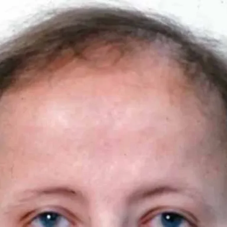 Pictures of Frontal Fibrosing Alopecia