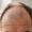 Hair Loss from Tirzepatide