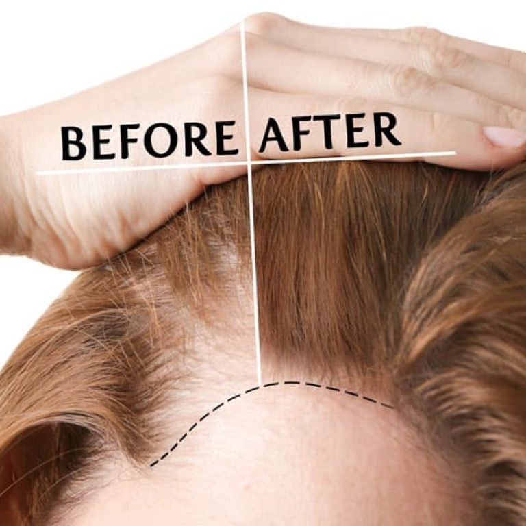 Hair Transplant for Female Pattern Baldness