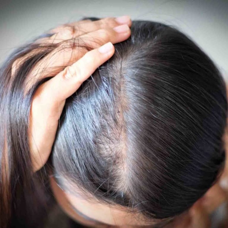 Hair Loss and Depo Provera