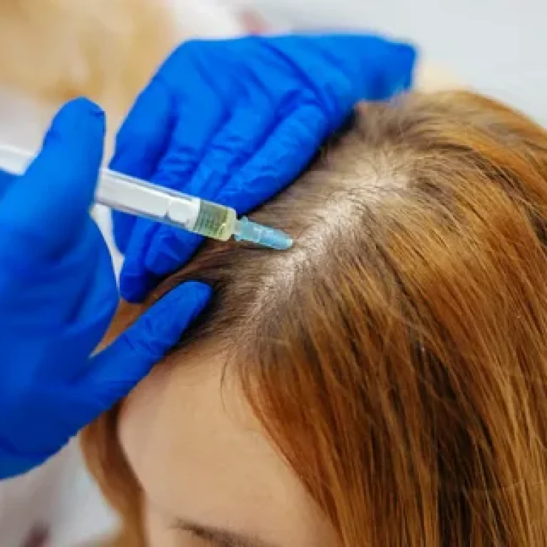 Early Frontal Fibrosing Alopecia