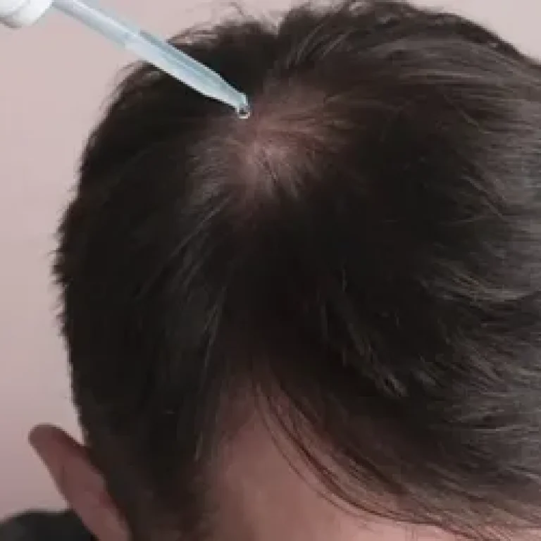 potential side effects of hair cloning