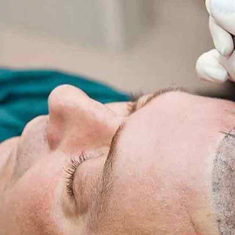 Modern Hair Transplants