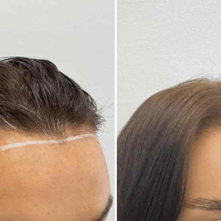 Female Hair Transplant in Islamabad
