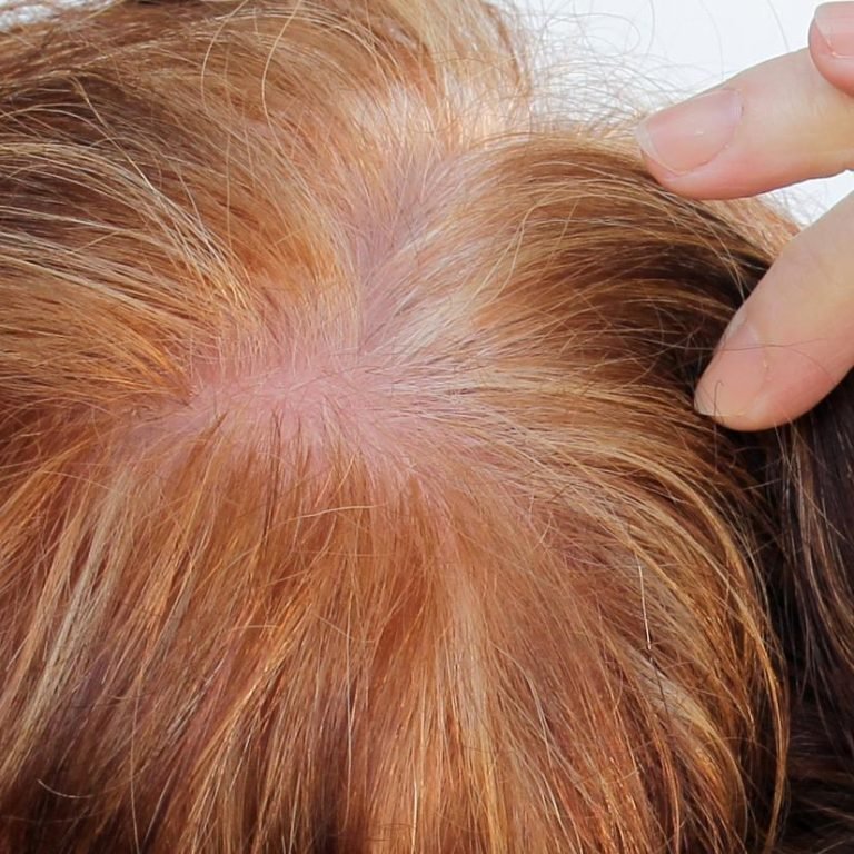 Can Highlighting Hair Cause Hair Loss