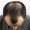 Stage 2 Hair Fall
